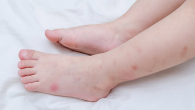 How Long Do Bed Bug Bites Last? Healing Timeline