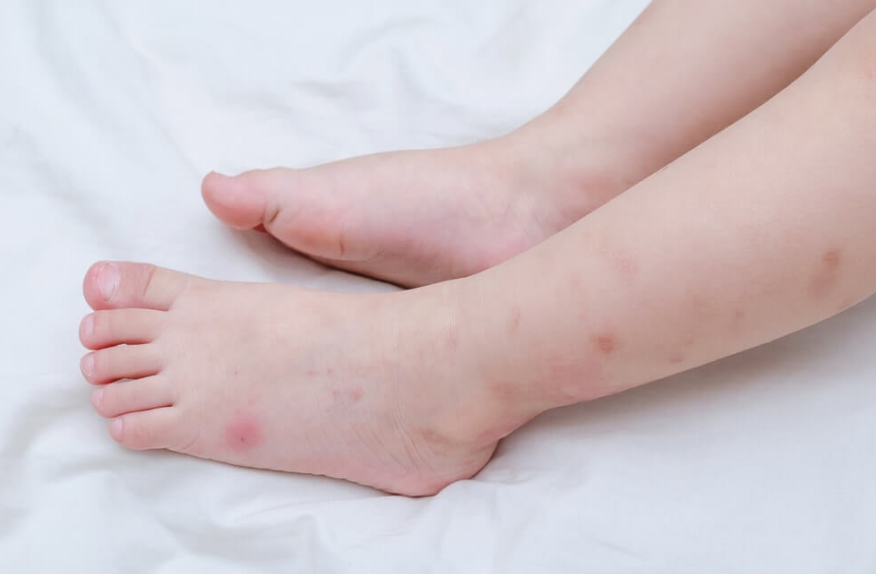 How Long Do Bed Bug Bites Last? Healing Timeline